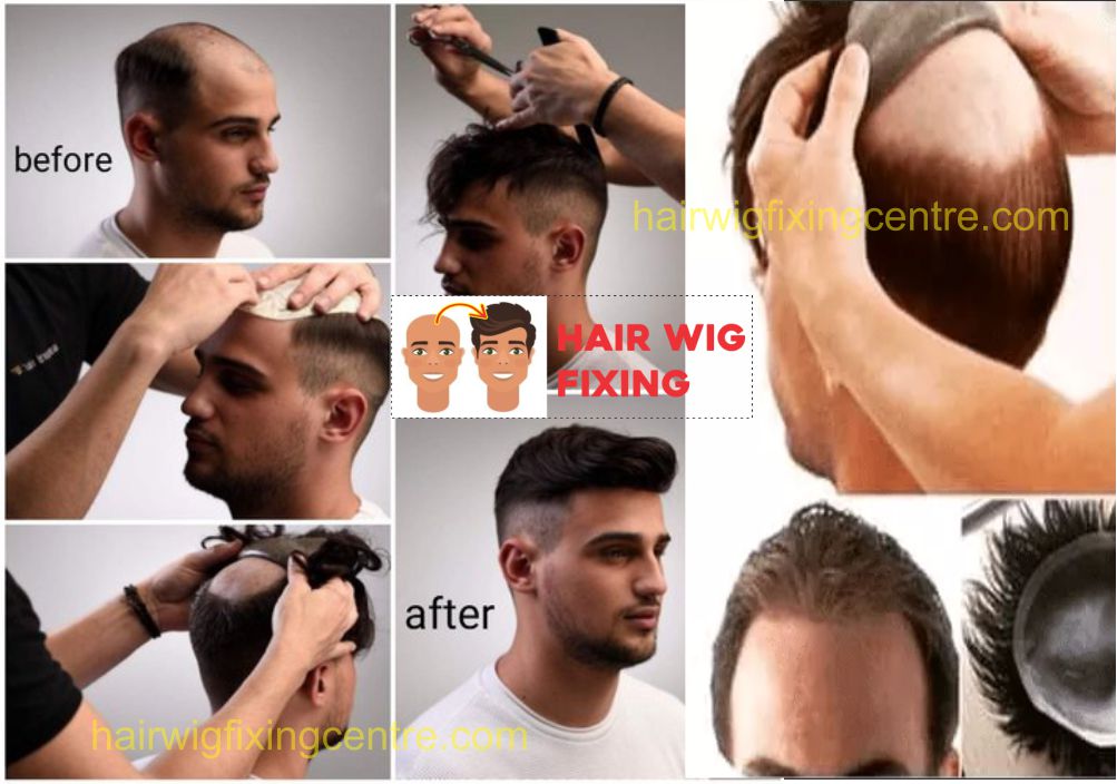 Non-Sugical Hair Replacement Treatment of Hair Loss Problem in Men in Kolkata and Howrah